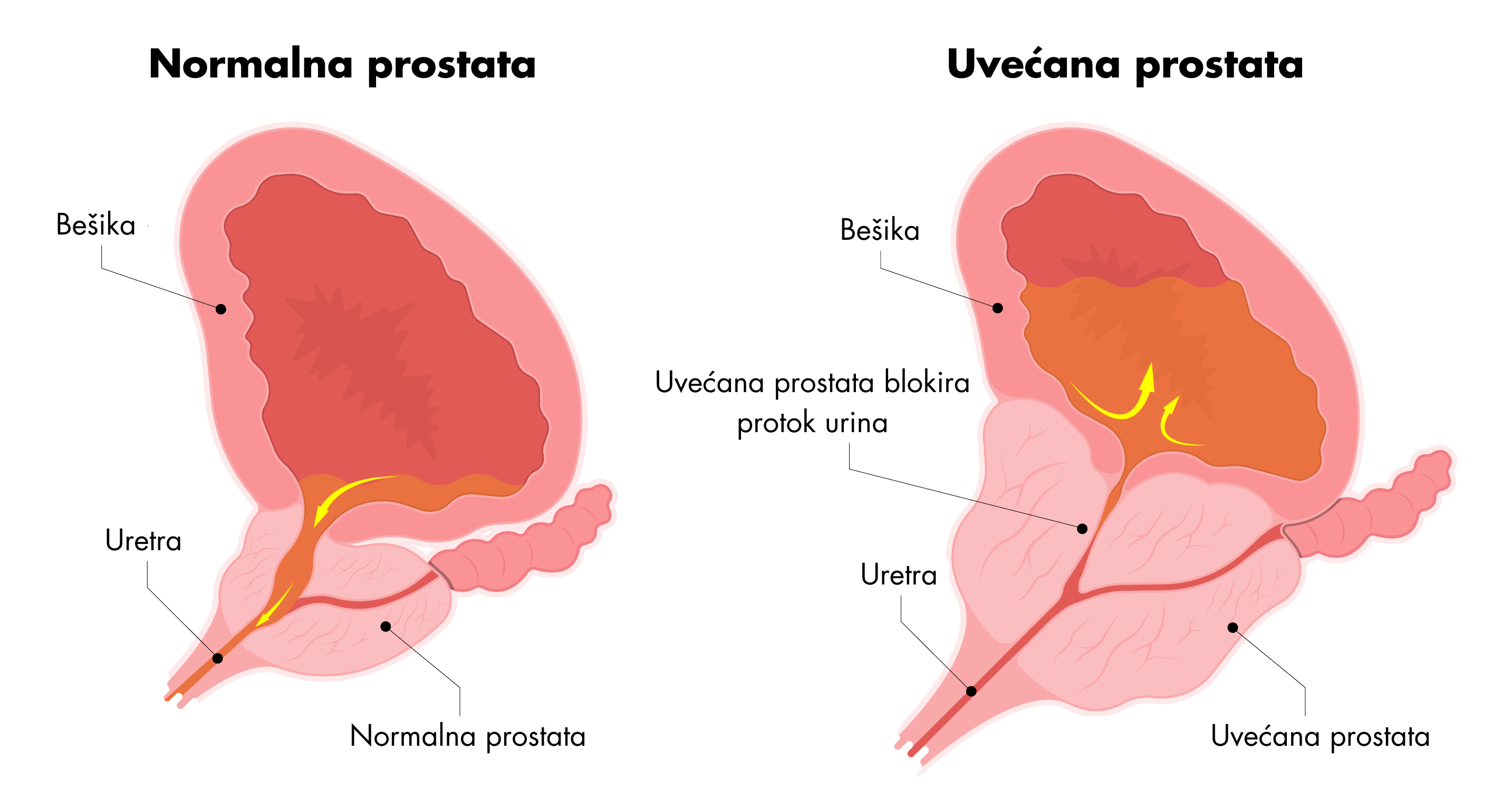 Prikaz normalne i uvećane prostate
